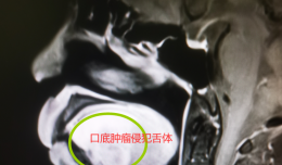 【欽二醫(yī)技術(shù)】口底癌侵犯舌體并頸淋巴結(jié)轉(zhuǎn)移，專家妙手成功再造舌體