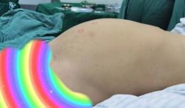 【欽二醫(yī)技術】單孔腹腔鏡下切除巨大卵巢腫瘤 抽出囊液8500ml